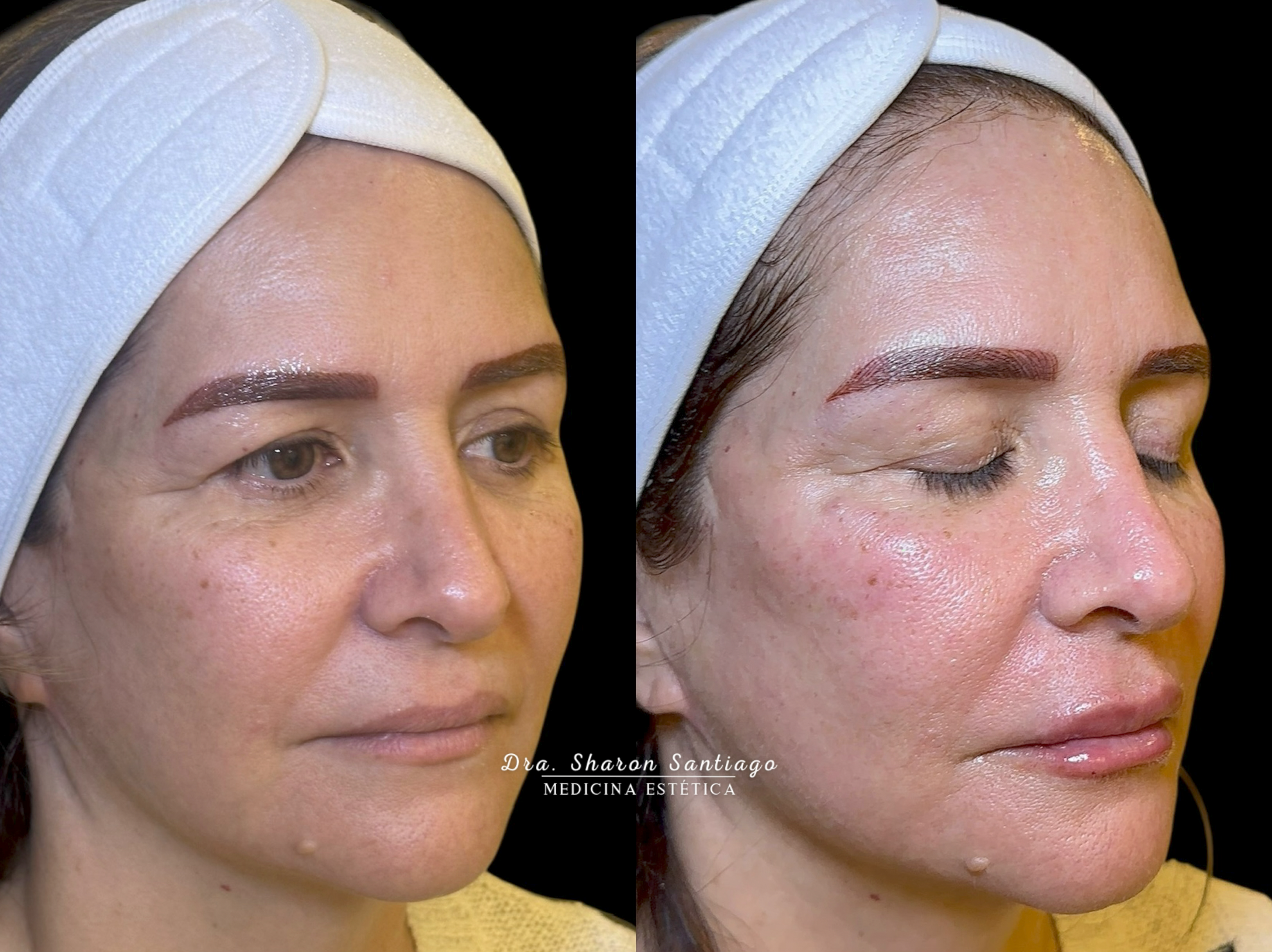 Armonización facial