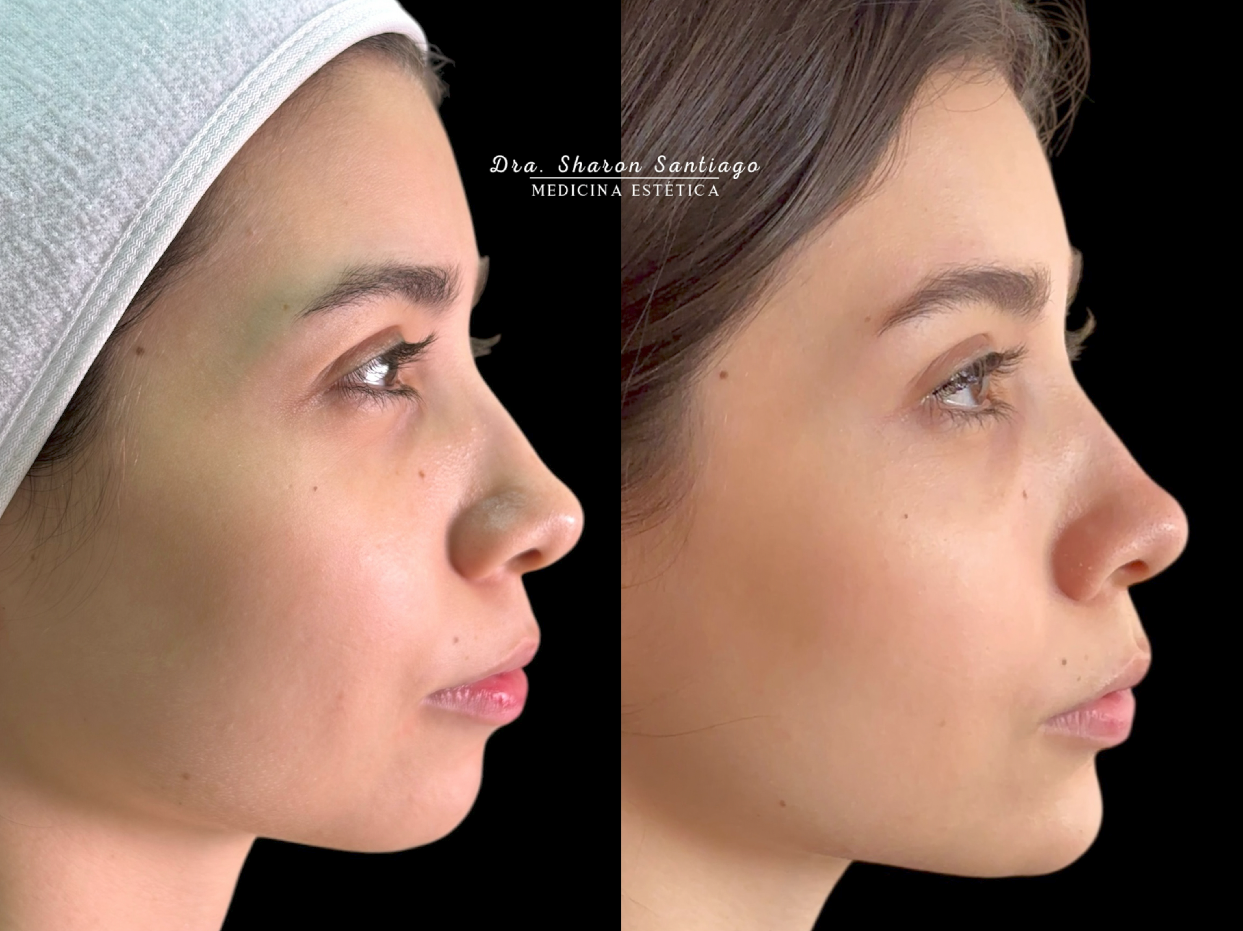 Rejuvenecimiento cutáneo